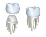 Пластмассовые коронки на зубы - цена, установка, рекомендации