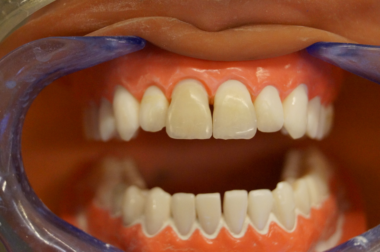 Зубная реставрация. Восстановление передних зубов композитным материалом. Художественное наращивание зубов.